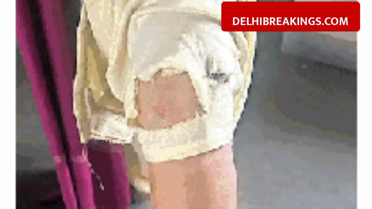 delhibreakings stray dog attack vasant kunj delhi news Stray Dog Menace in Vasant Kunj: Domestic Help Attacked, 15 People Bitten in January