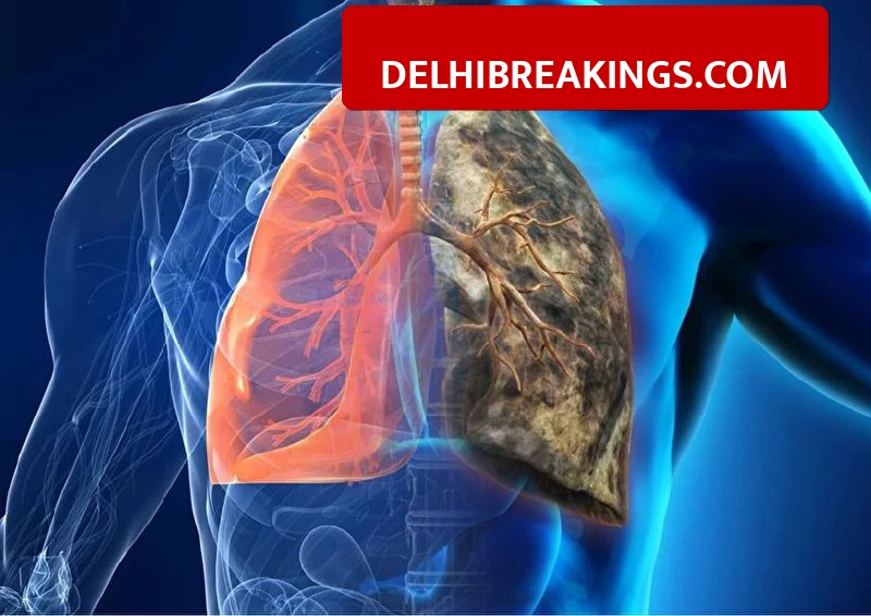 delhibreakings delhi men cancer risk icmr report lung oral prostate causes Delhi Men Beware, Doctors List 3 Cancers Spreading Rapidly Due to Pollution and Lifestyle