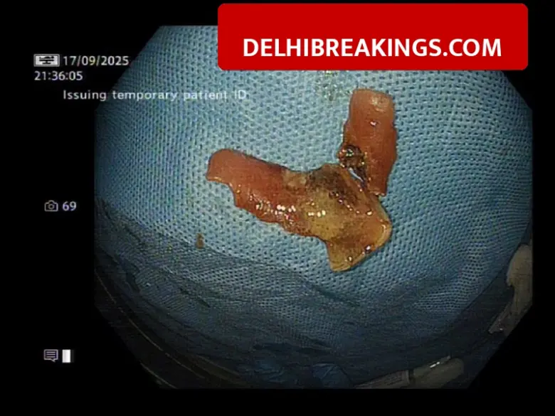 delhibreakings sir ganga ram hospital laser denture removal medical breakthrough Sir Ganga Ram Hospital Doctors Use Laser Technology to Remove Stuck Denture Without Major Surgery